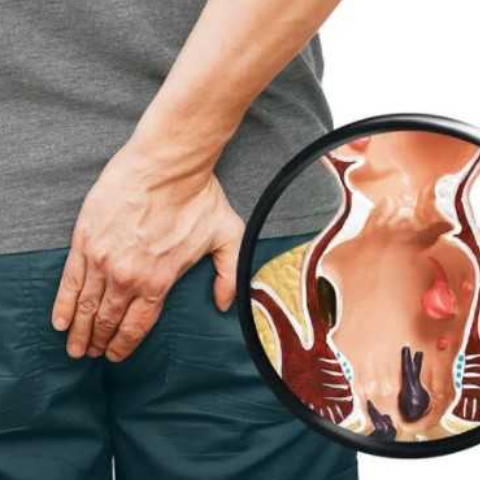 Piles Treatment in Kelambakkam