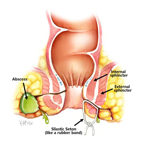 Pain Free Anal Fistula Treatment in Kelambakkam