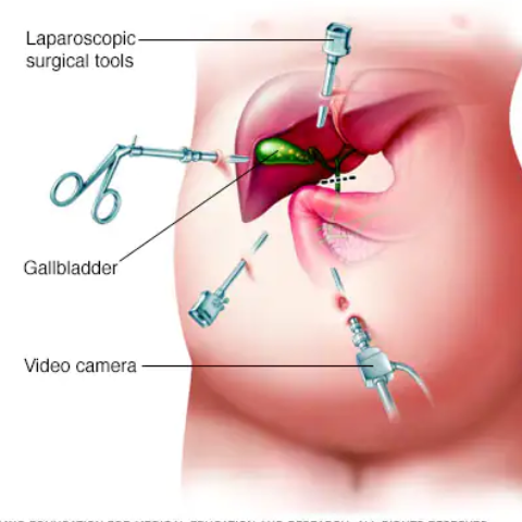 Gallbladder Stone Specialist in Kelambakkam
