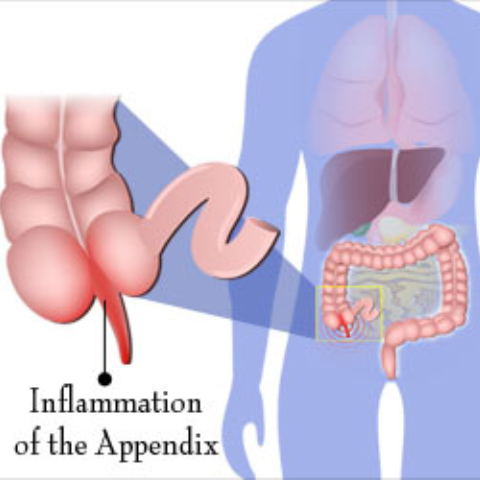 Appendix Removal Surgery in Kelambakkam